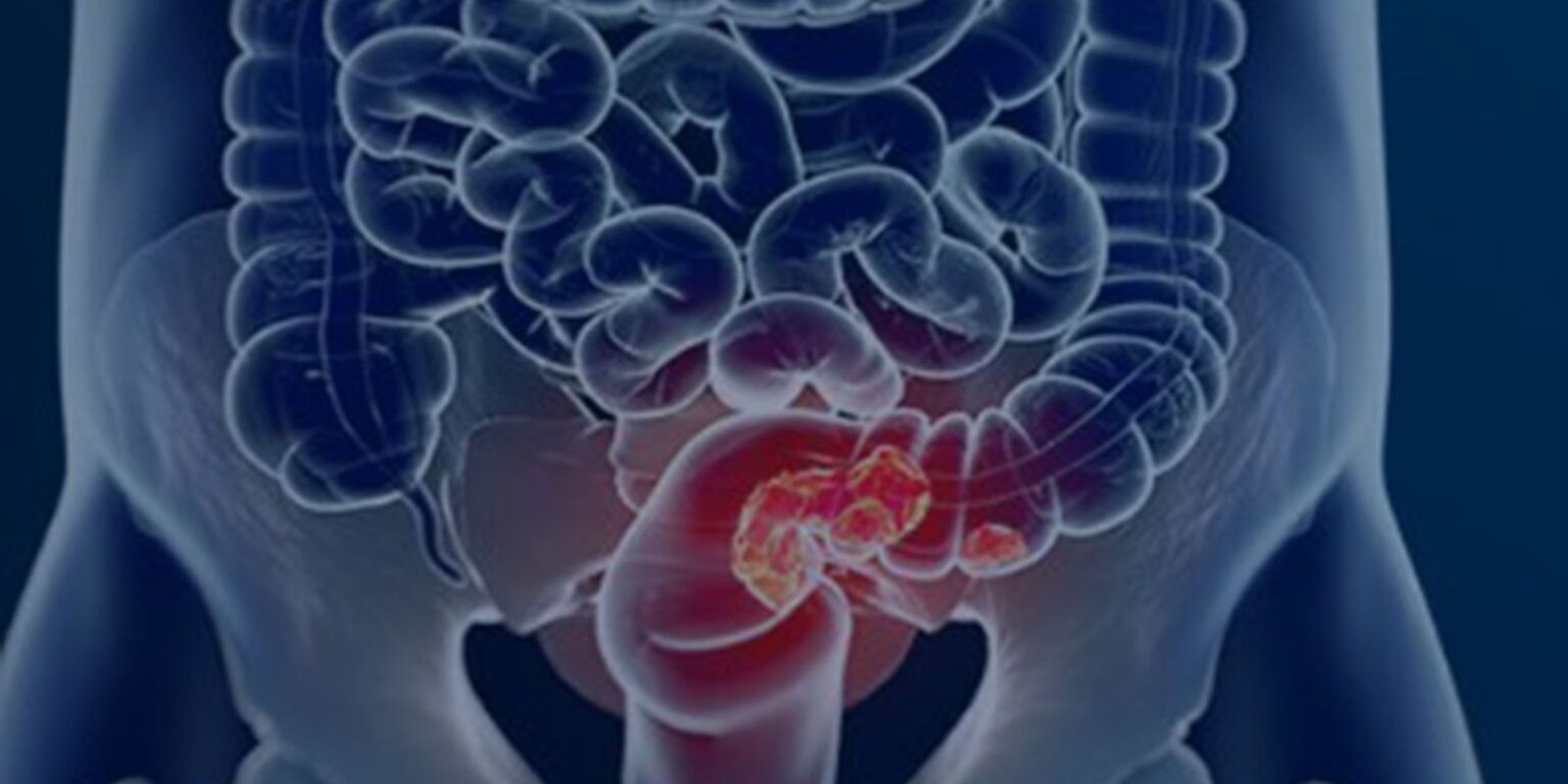 estudo-projeta-aumento-de-36%-em-mortes-por-cancer-colorretal-ate-2040