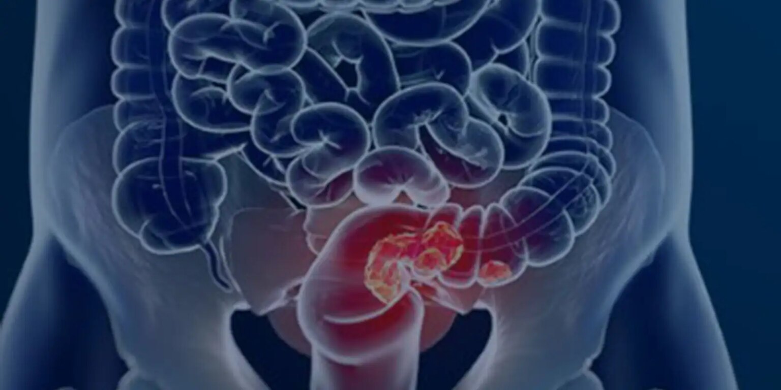 sus-adota-novo-exame-para-rastrear-cancer-colorretal-na-populacao